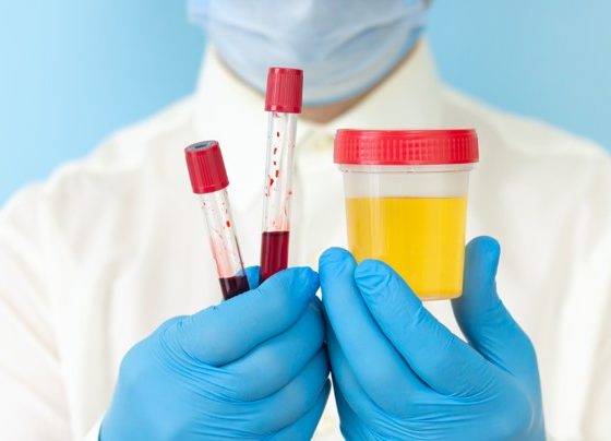 ¿Es posible detectar cannabidiol en los análisis de sangre y orina? 30